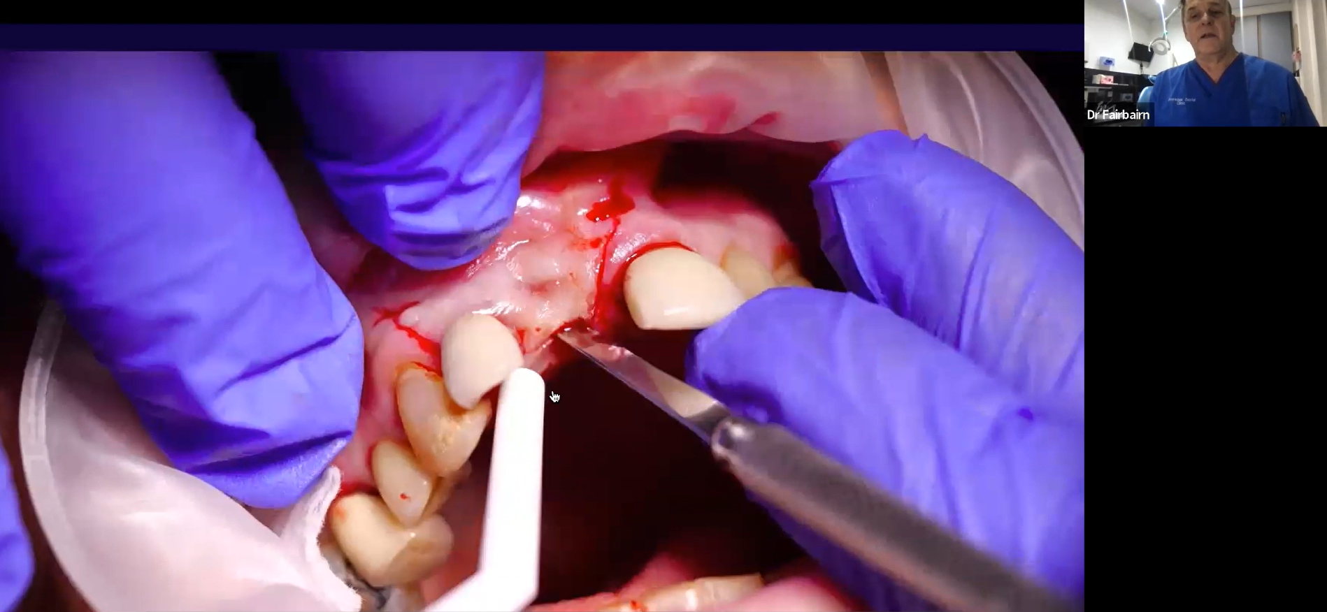 Image supporting a Live Surgery Walkthrough with Dr Fairbairn. Image shows a graphic photo of teeth and gums during a dental procedure.